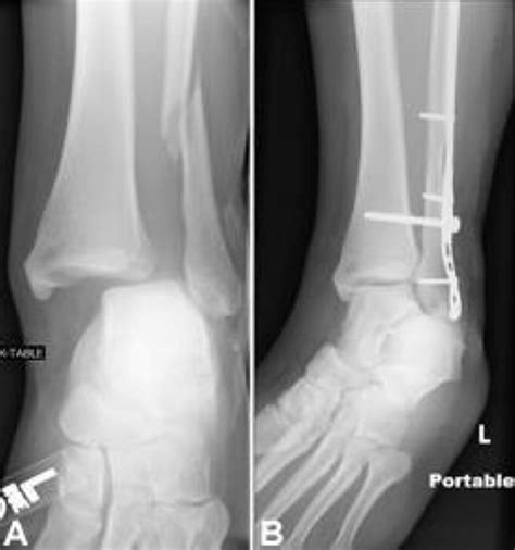 Broken Ankle Fractured Ankle Broken Foot Stress Fracture Ankle