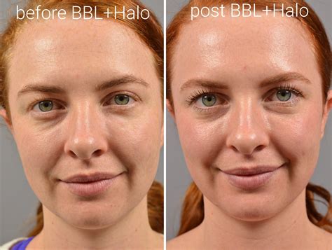Aprender Acerca 59 Imagen Halo Skin Treatment Before And After