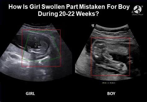 How Is Girls Swollen Part Mistaken For Boy During 12 22 Weeks