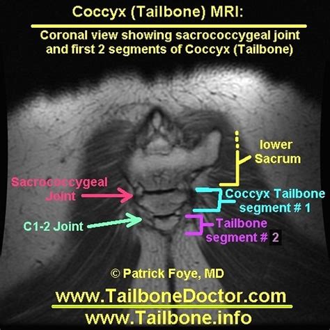 Tailbone Mri Coccyx Pain Foye Tailbone Mri Coccyx Mri Flickr