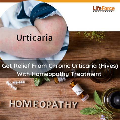 Get Relief From Chronic Urticaria Hives With Homeopathy Treatment