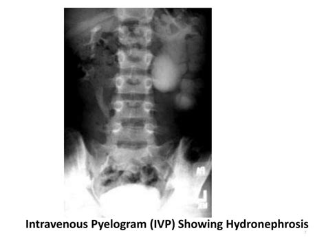 Ppt Urology 4 Hydronephrosis Powerpoint Presentation Id140394