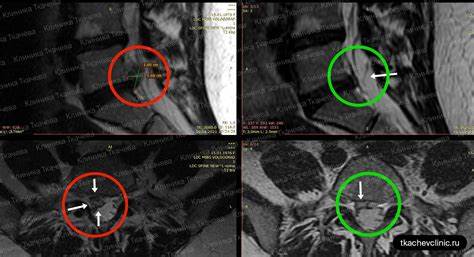 Грыжа в пояснично-крестцовом отделе после 1 курса резорбции (1.6 х 1.1 Картинка - Грыжа в пояснично-крестцовом отделе после 1 курса резорбции (1.6 х 1.1