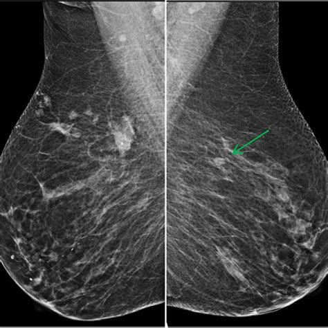 Diagnostic Mammogram Mlo View Of The Right Breast Left Image Shows