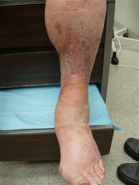 Skin Hardening On Legs