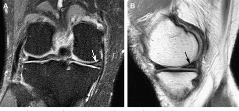 Figure From The Role Of The Meniscus In Knee Osteoarthritis A Cause