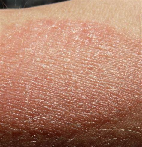 Dry Scaly Patches On Skin All In One Photos