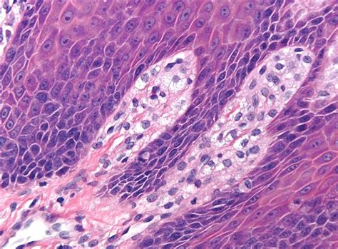 Pathology Outlines Cutaneous Verruciform Xanthoma