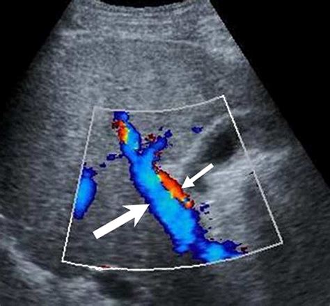 Non Invasive Evaluation Of Liver Cirrhosis Using Ultrasound Clinical