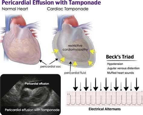 Pericardial Effusion With Tamponade Rosh Review Cardiovascularnursing