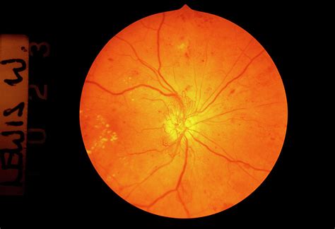 Retina Damage In Diabetes Photograph By Paul Parkerscience Photo