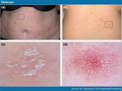 Dermoscopy For Diagnosis Of Inflammatory Skin Diseases