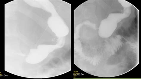 Case 3 Upper Gi Series Left Done Showing Gastric Twist At The Level