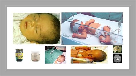 Ictericia E Hiperbilirrubinemia Neonatal Youtube