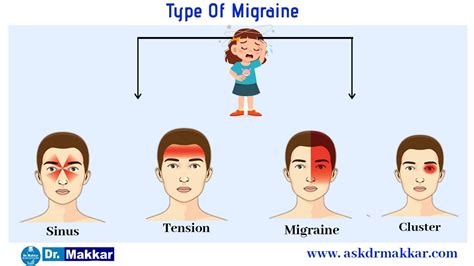 Migraine Homeopathic Cure Treatment Using Homeopathy With Excellent