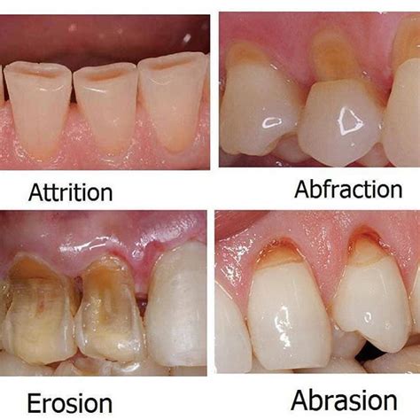 Difference Between Dental Erosion Enamel Attrition Abfraction And
