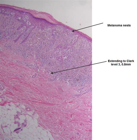 Dermpath Made Simple Neoplastic Melanoma Superficial Spreading And