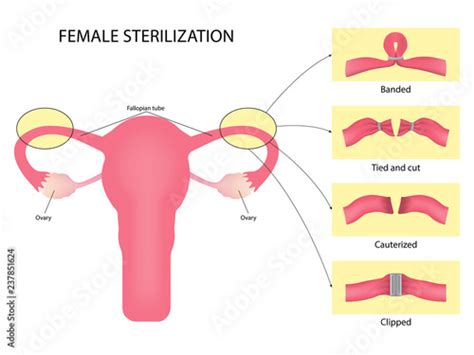 an overview of tubal ligation surgery as a form of female sterilization buy this stock vector