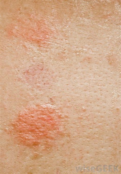 What Are The Most Common Causes Of Circular Rashes
