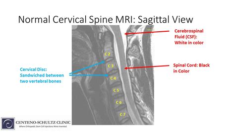 Differences Between A Normal And An Abnormal Mri Of The Cervical Spine