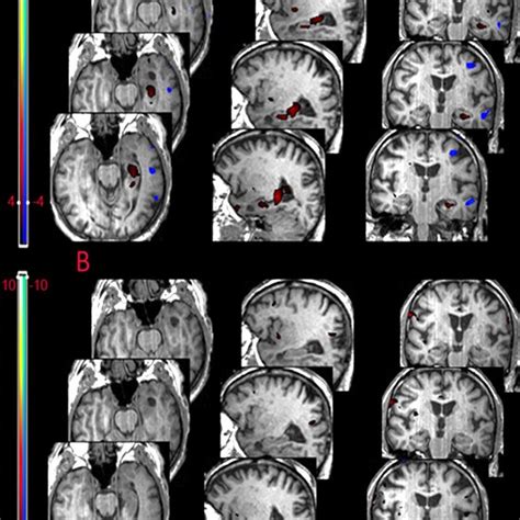 Example Of Patient 1 Suffering From Left Temporal Lobe Epilepsy Due