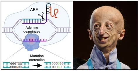 Brief Expression Of Gene Editing Tools Helped With Progeria In Mice