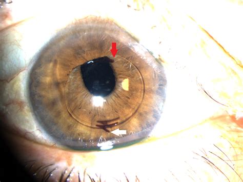 Cureus Late Intraocular Lens Dislocation Resulting From Haptic