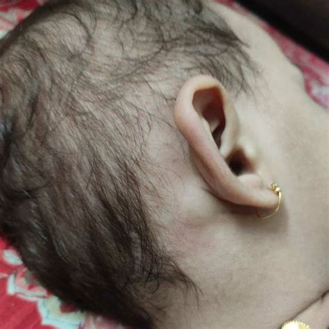 Swollen Lymph Nodes Behind Ear