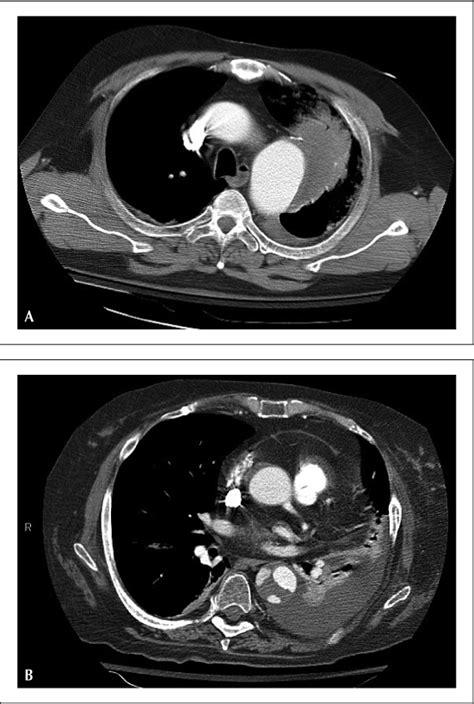 Image Diagnosis Thoracic Aortic Dissection And Thoracic Aortic