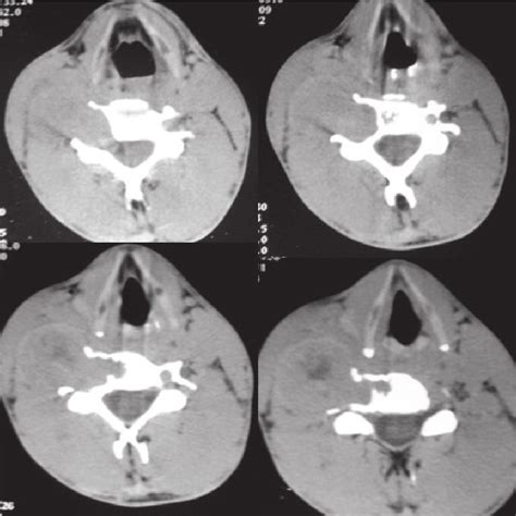Plain Ct Scan Showing A Dumbbell Tumor On Right Side With Widening Of
