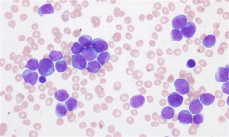 Acute lymphoblastic leukemia (all) — classification, laboratory evaluation, and survival rate. Acute Lymphoblastic Leukemia | Clinician's Brief