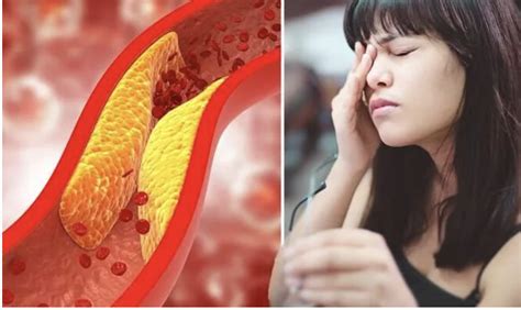 High Cholesterol Symptoms The Sign That ‘almost Always Happens In Just