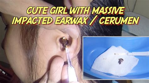Cute Girl With Massive Impacted Earwax Cerumen Removal Youtube
