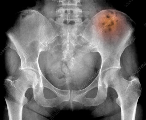 Bone Marrow Cancer X Ray Stock Image C0207258 Science Photo Library