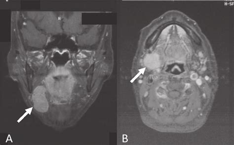 Magnetic Resonance Imaging Mri Of The Submandibular Glands Mri