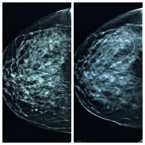 The D Mammogram On The Right Shows The Breast Cancer Much Better Than