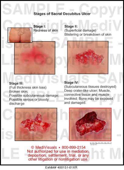 Bed Sores Stages