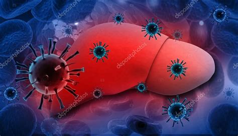Liver Infection With Hepatitis Viruses ⬇ Stock Photo Image By
