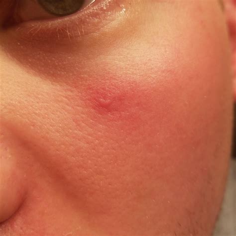 Skin Concerns Can Anyone Tell Me What This Thing Is On My Face And