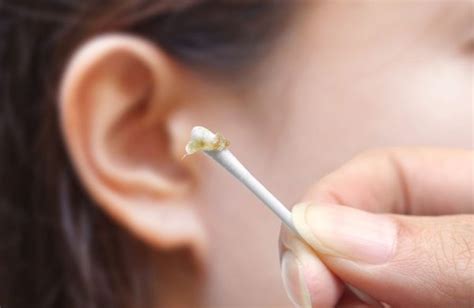 What Is Ear Wax Anglia Ear Care Solutions