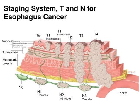 Esophageal Cancer Stages