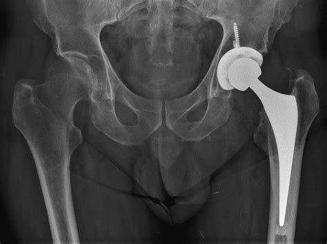 Hip Replacement Adelaide Total Hip Replacement Adelaide Dr Sunil Reddy
