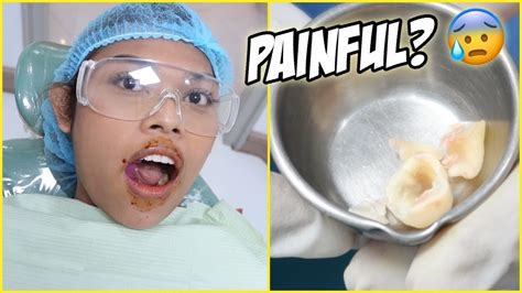 Wisdom Tooth Removal Does It Hurt Honest Experience Youtube