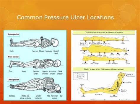 Pressure Ulcers Prevention And Treatment Jennifer A Gardner Wound Care