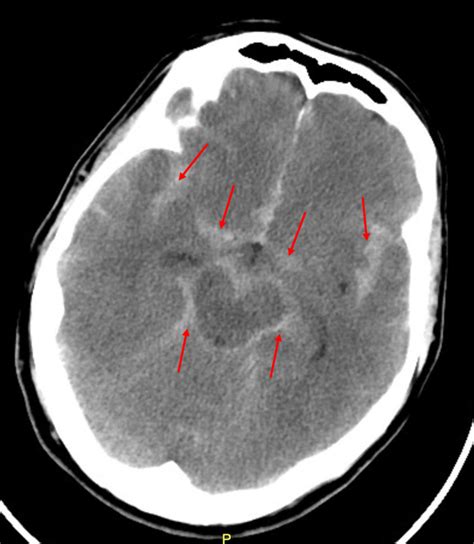 Subarachnoid Hemorrhage On Ct Head Download Scientific Diagram