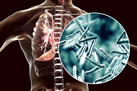¿qué Es La Tuberculosis Y Cómo Se Contagia Instituto De Neumología