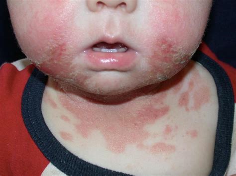 Drool Rash Treatment Prevention And When To See A Doctor