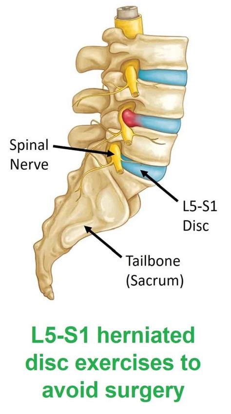 L5 S1 Herniated Disc Relief With 3 Exercises To Avoid Surgery