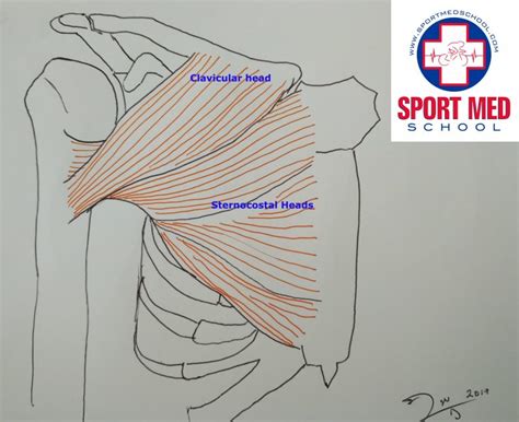 Pectoralis Major Tearrupture Sport Med School