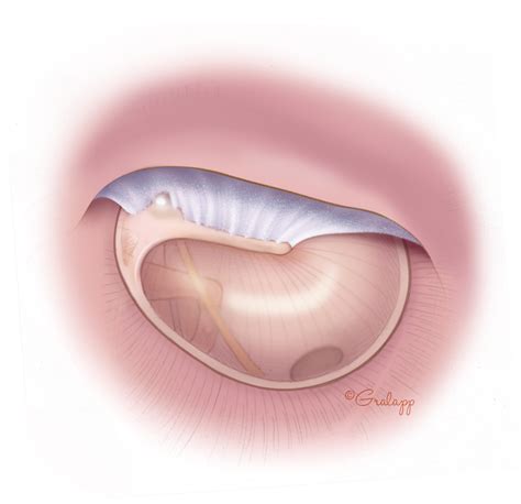 Lateral Graft Tympanoplasty Oto Surgery Atlas